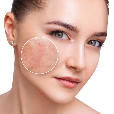 Young woman with couperose on face skin in zoom circle. Isolated on white.