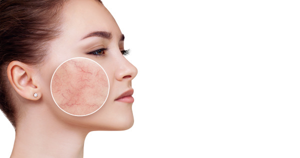 Young woman with couperose on face skin in zoom circle. Isolated on white background. Copy space.